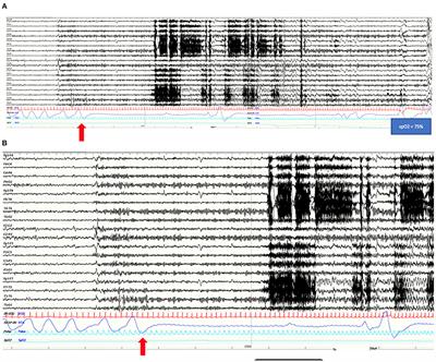 Case Report: Ictal Central Apnea as First and Overlooked Symptom in Temporal Lobe Seizures